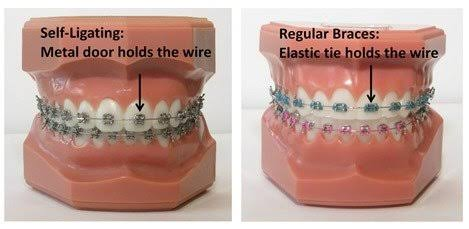 Perbandingan Self-Ligating vs Konvensional. Sumber: Center for Dental Implants & Esthetics